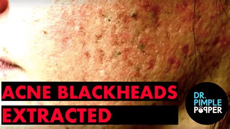 Acne & Blackheads extracted by Dr. Sandra Lee - Dr. Pimple Popper