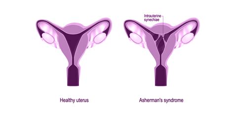 Intrauterine Adhesions and Infertility in Women