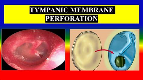 Tympanic Membrane Granulation Tissue