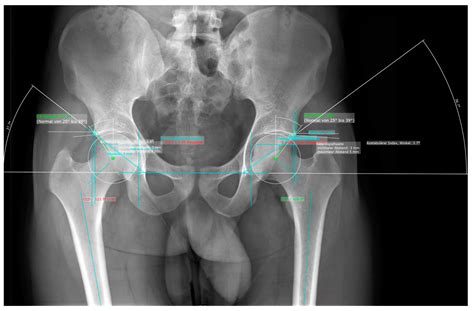 Osteoarthritis Hip X Ray Findings