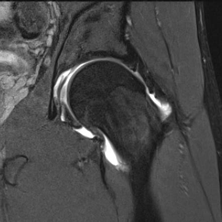 Femoral retroversion | Image | Radiopaedia.org