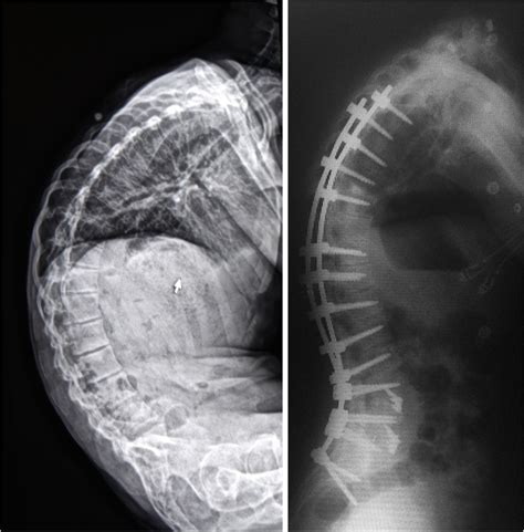 Clinical Gait Analysis on a Patient Undergoing Surgical Correction of ...