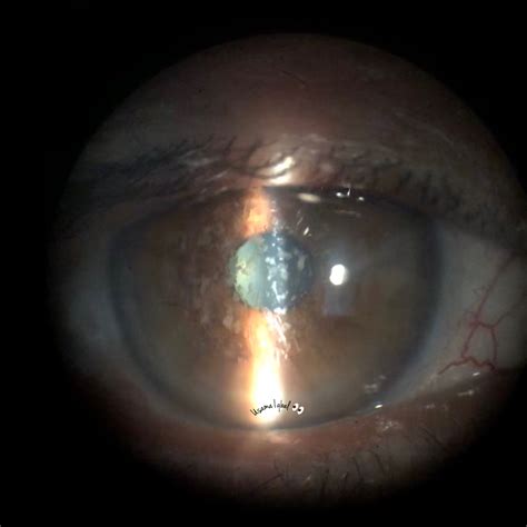 Granular corneal dystrophy - American Academy of Ophthalmology