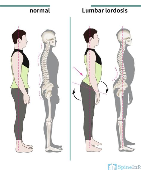 Lordosis: Definition, Causes, Symptoms, Diagnosis, and Treatment ...