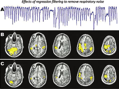 Functional MRI (fMRI) activation maps depicting the effects of ...