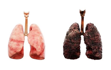 Non Smoker Lungs Vs Smoker