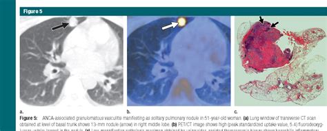 Figure 18 from Imaging of pulmonary vasculitis. | Semantic Scholar