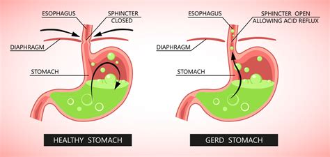 Gastroesophageal Reflux Disease (GERD) - Symptoms, Causes Patient9.com