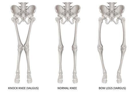 Varus Valgus Knee Deformity