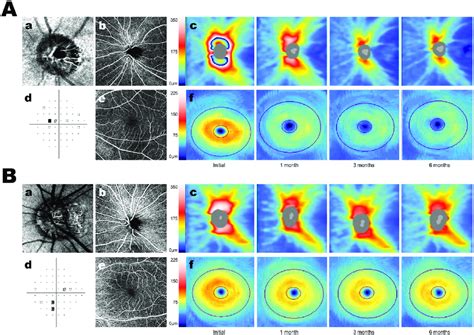 Representative cases of optic neuritis patients depending on the ...