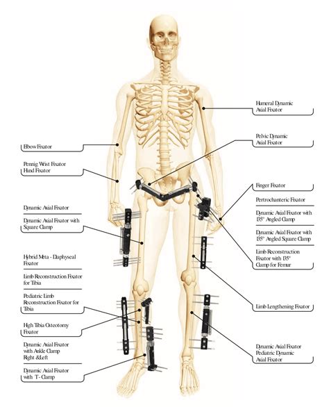 Ultimate Guide of External Fixator - Orthopromed Inc. Medical