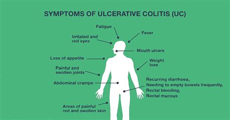 Ulcerative Colitis Symptoms