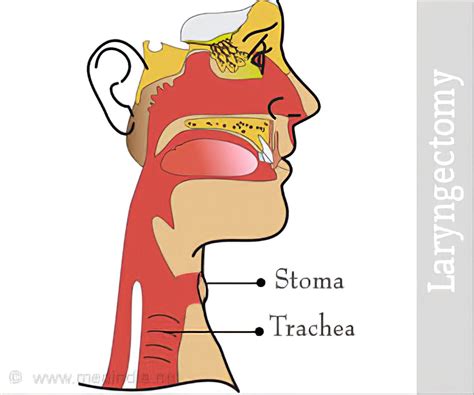 Laryngectomy - Procedure, Risks and Post Laryngectomy Therapy