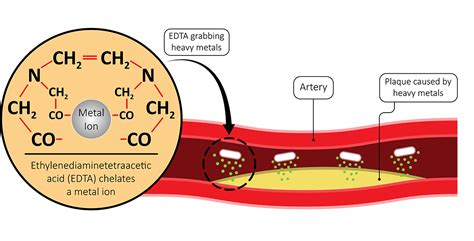 IV Chelation Therapy - Heavy Metal Treatment - Dr. Lalezar