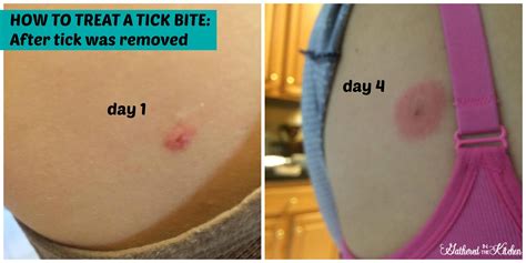 What To Do If You Get A Tick Bite | Tick bite, Ticks, Bitten