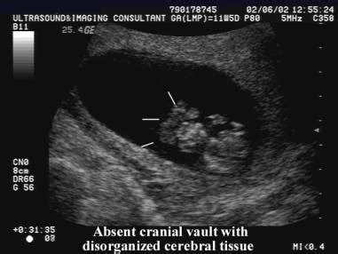 Anencephaly Ultrasound Findings