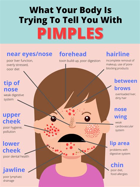 Acne Chart, Back Pimples, Pimples On Face, Pimple Causes, Acne Causes ...