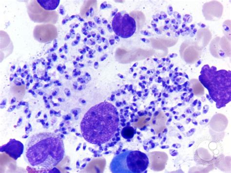 LD body infestation in bone marrow aspirate - 1.