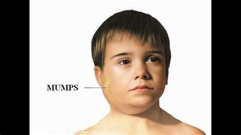 Biggest mumps outbreak in 22 years occurring in Texas | newswest9.com