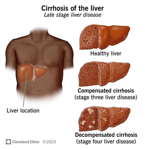 Understanding Cirrhosis: Causes, Symptoms, And Treatment - Ask The ...