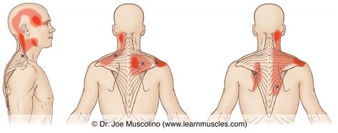 Trapezius (Trap) - Trigger Points - Learn Muscles