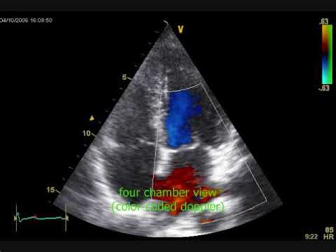 echocardiography with sound and arrhythmia - YouTube