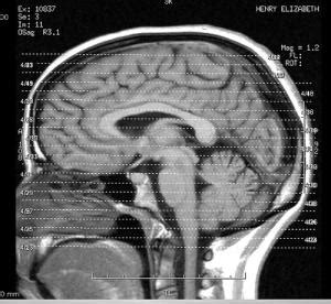 Brain stem injury | General center | SteadyHealth.com