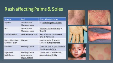 Syphilis Rash On Palms