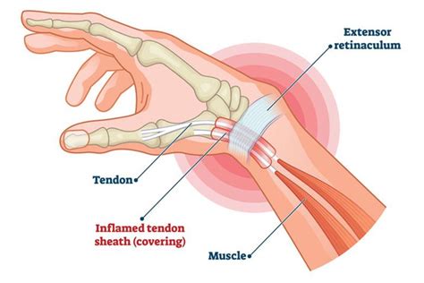 De Quervain's Tenosynovitis (Painful Wrist) - Causes and Symptoms ...