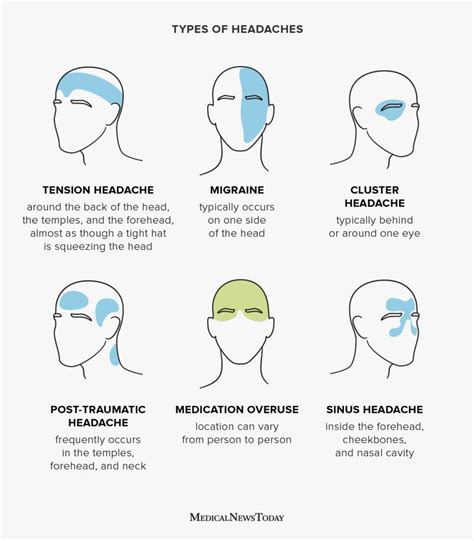 Headache chart: Types by symptoms, location, and causes