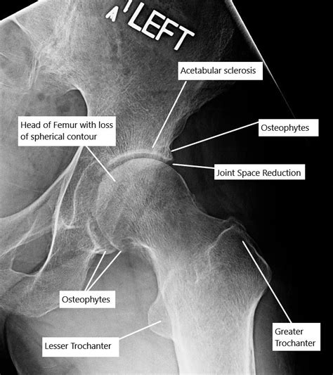 Osteoarthritis - Complete Orthopedics | Multiple NY Locations