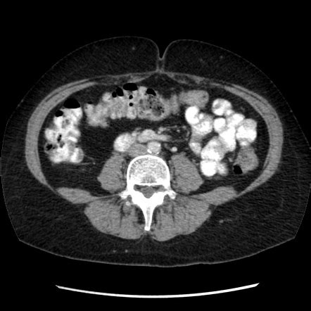 Why Ct Scan Abdomen Pelvis