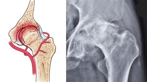 Proximal femoral fracture