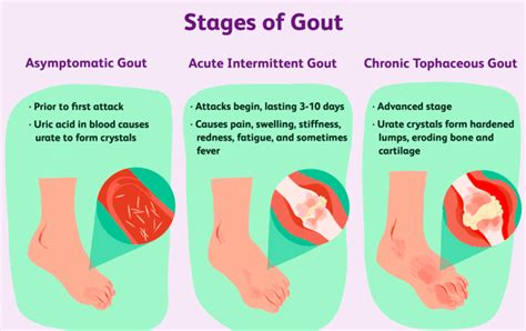 What is Gout - Hohman Rehab and Sports Therapy