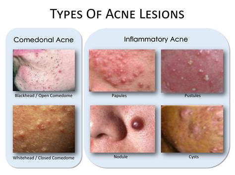 Acne: What’s The Deal?