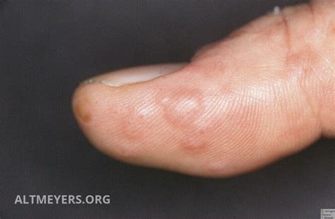 Dyshidrotic Eczema: Symptoms, Causes, And Treatment