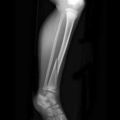 Tibial Fractures