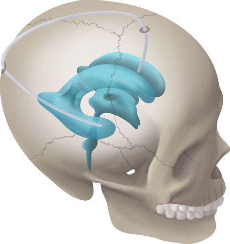 Frontiers | Refined Temporal-to-Frontal Horn Shunt for Treatment of ...