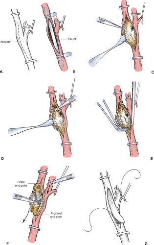 Carotid Endarterectomy | Basicmedical Key