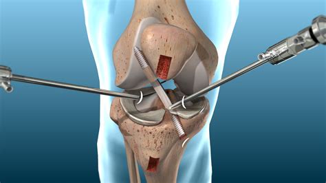 ACL Reconstuction Surgery