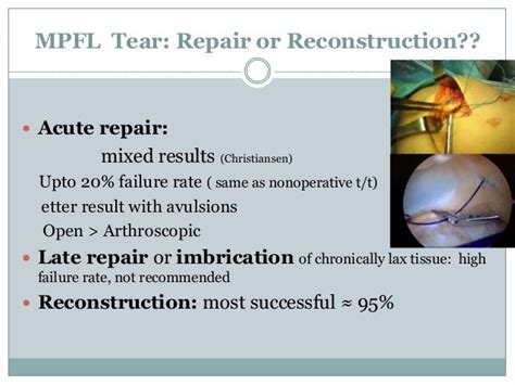 Medial Patellofemoral Ligament (MPFL) reconstruction 2014