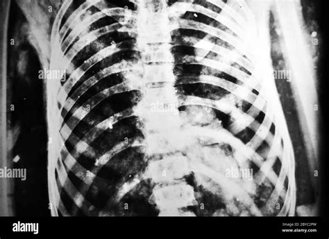 Vertebra xray Black and White Stock Photos & Images - Alamy