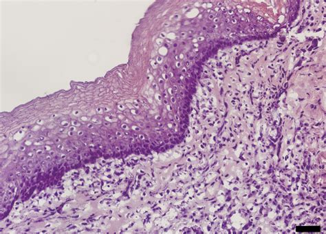 Keratinized epithelium - Karolinska Institutet