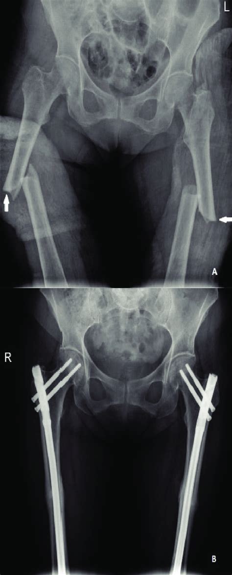 Bilateral atypical femur fracture (AO/OTA 32A3) A. Preoperative ...