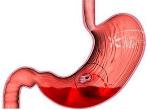 Gastrointestinal Bleeding | Global event | USA | Europe | Middle East ...