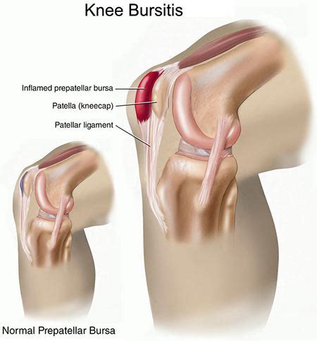 Knee Bursitis Treatment in New York City