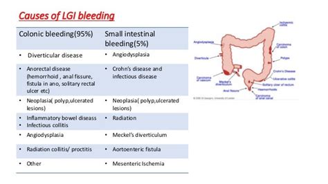 Lower Gi Bleed Causes - Upper gi tract bleed - Morphologic ...