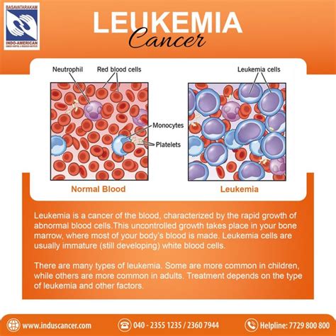 Comprehensive Guide to Leukemia: Symptoms, Causes, Treatment, Types ...