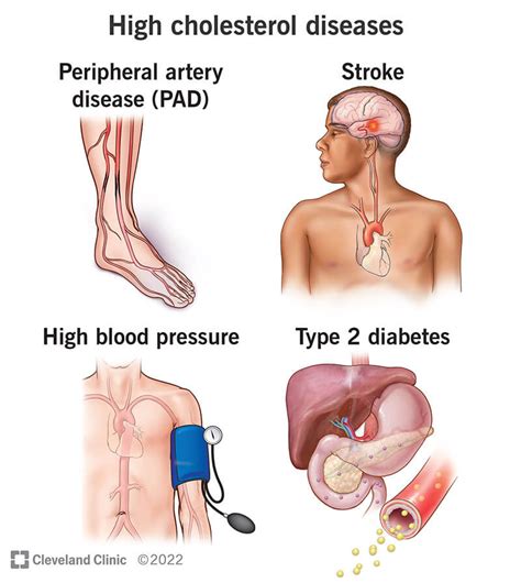 High Cholesterol: Causes, Symptoms and How It Affects the Body