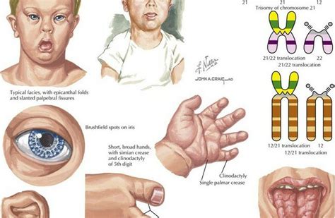 Symptoms of Trisomy 21 (Down Syndrome) – Healthy Food Near Me